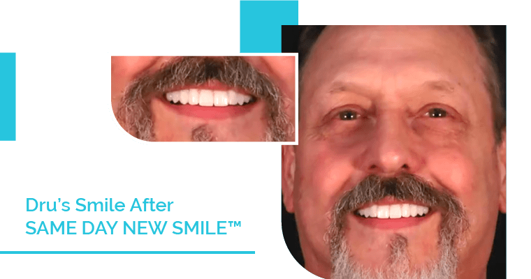 Dru's Smile After Same Day New Smile