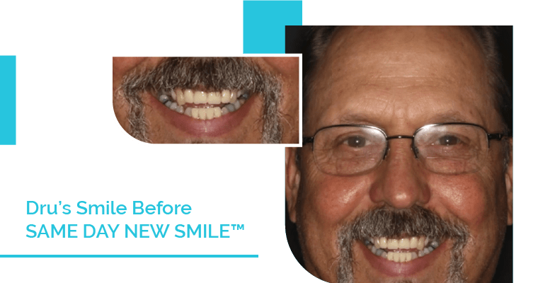 Dru's Smile Before Same-Day New Smile