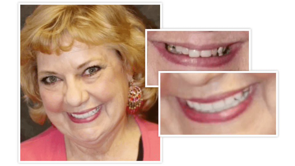 A photo collage of Gail before and after cosmetic treatment
