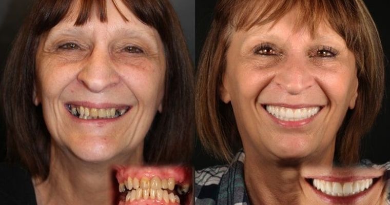 Before and after of patient getting full mouth reconstruction.